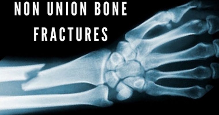 Non Union Bone Fractures