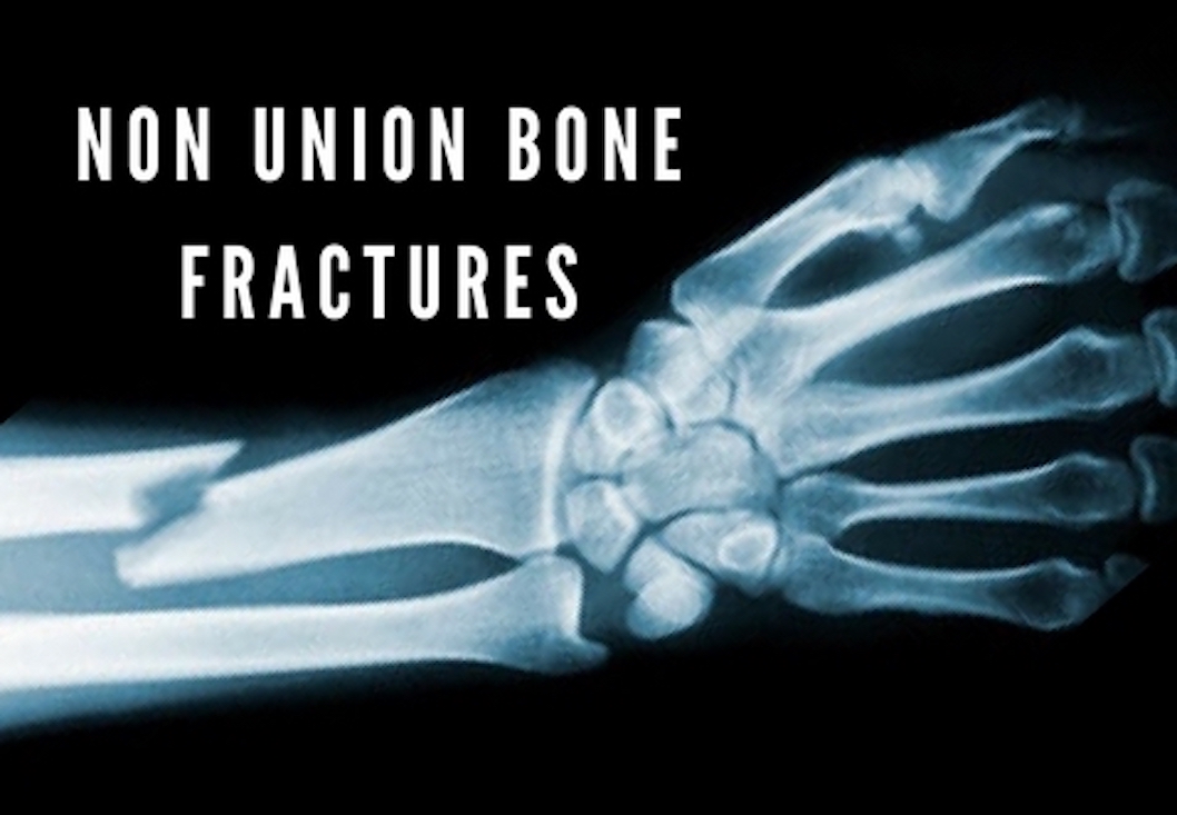 Non Union Bone Fractures